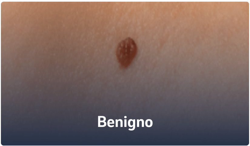 C - Benigno