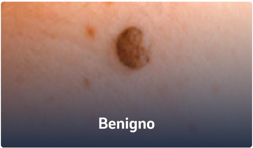 D - Benigno
