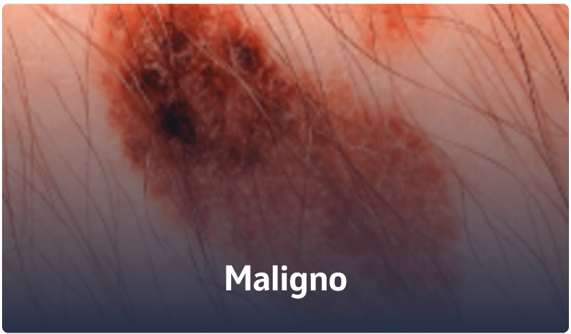 A - Maligno
