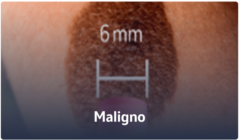 D - Maligno