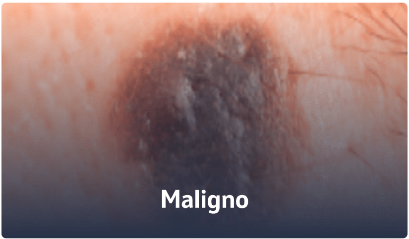 B - Maligno