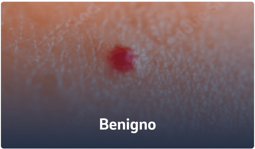 A - benigno