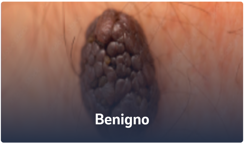 B - Benigno